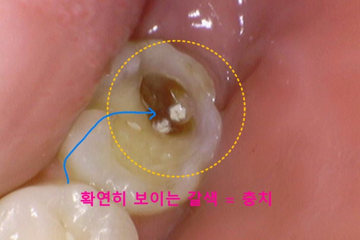 치과에서 방사선 사진을 꼭 찍어야 하는 이유? 하남치과 미사치과 신장동치과