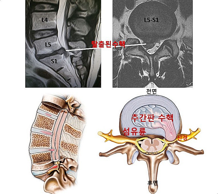 추간판탈출증의 원인 및 증상을 이해하고 좋은 자세(요추전만)를 일상에 적용하자. : 네이버 블로그