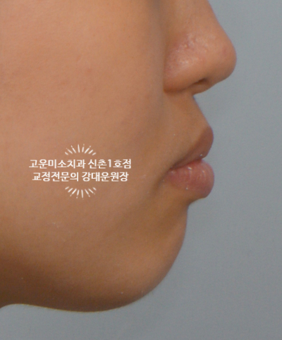 돌출입 발치치료증례 신촌교정치과 교정전문의 강대운원장 고운미소신촌1호점 치료증례