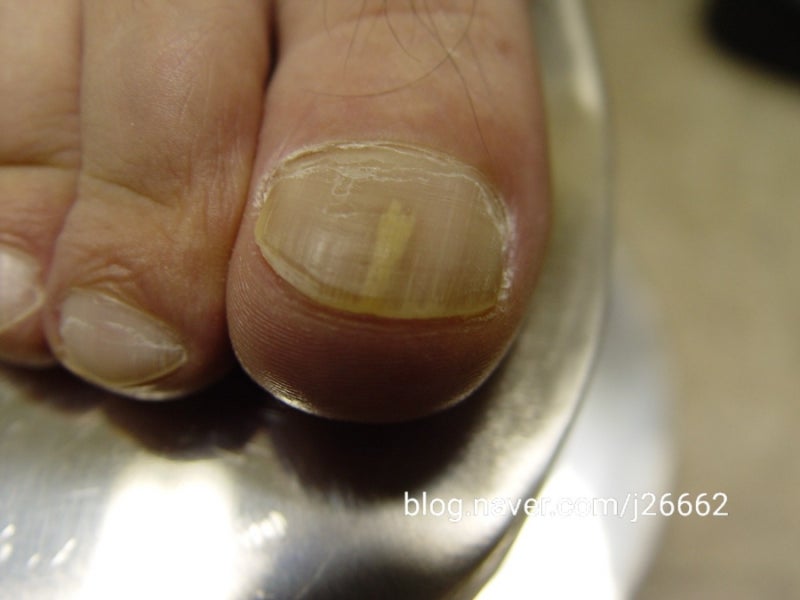 29. 손발톱백선증(조갑백선, Tinea unguium) : 네이버 블로그