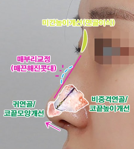  무보형물코수술후기_귀연골과 비중격연골이식으로 자연스러운 코라인으로