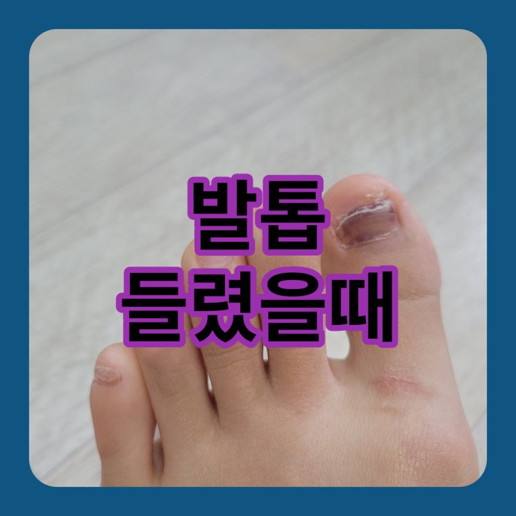  발톱 들렸을때 올바른 대처 방법 알아보자