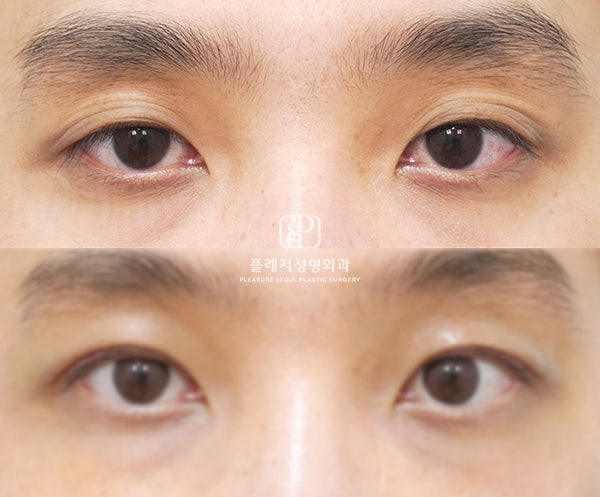 남자 홑눈 교정 리뷰) 성형 전 알아야 할 3가지 포인트