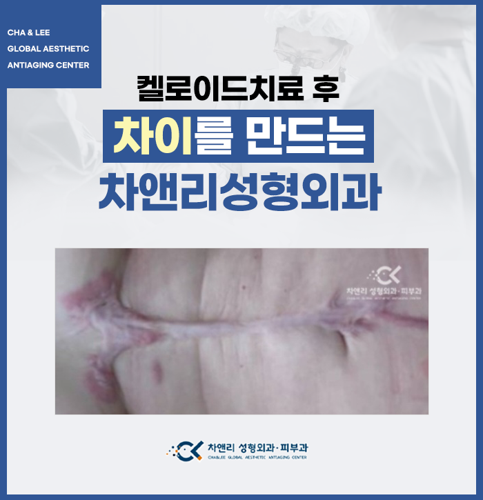  성형외과전문의 병원에서 받는 켈로이드흉터치료