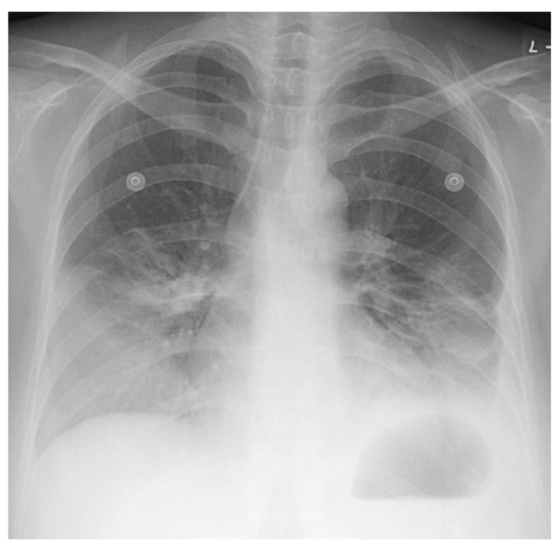 활동성 폐결핵 폐엑스레이 증례, 속립 결핵, 흉막삼출, Miliary TB : 네이버 블로그