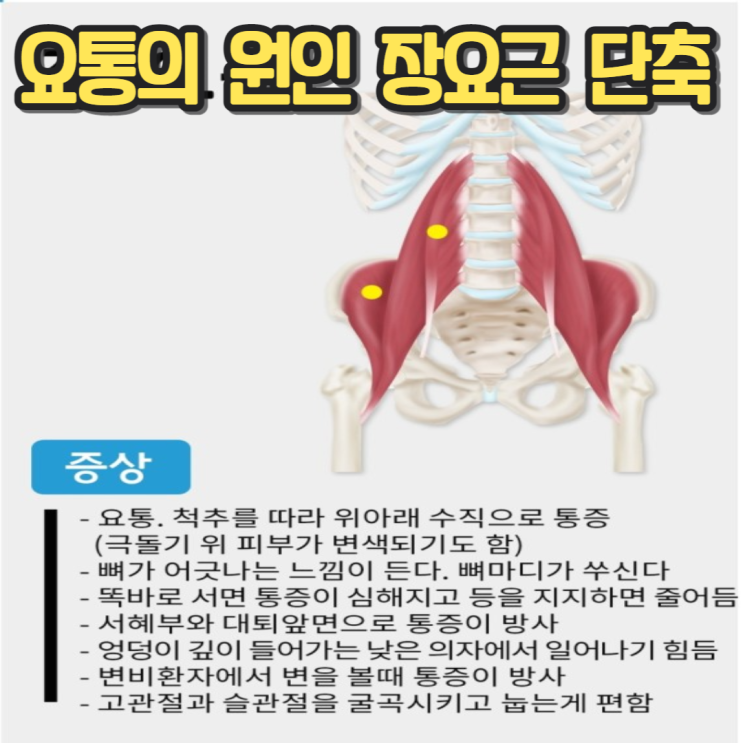 요통의 원인 장요근 단축, 발통점 & 방사통