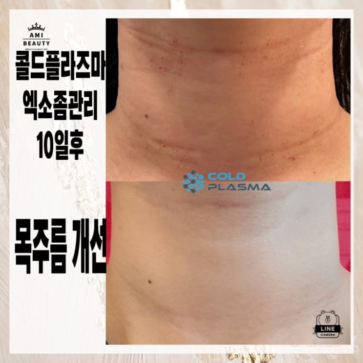  목주름 고민  콜드플라즈마 콜드mts 로 대구아미뷰티 에서 해결하세요