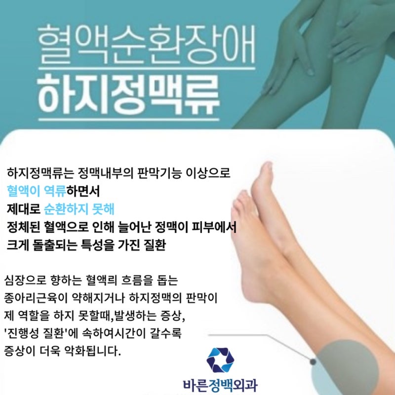 울산하지정맥류 케어 방법과 4