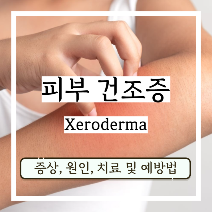 피부 건조증 증상 피부건선 원인, 치료 및 예방법 피부 건조증 증상 피부건선 원인, 치료 및 예방법