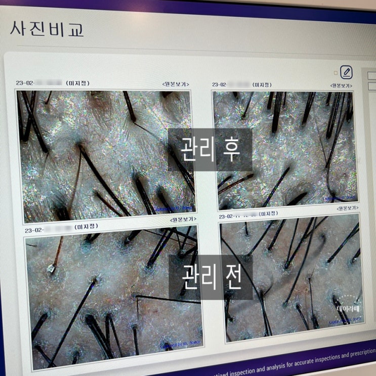  [연신내 탈모] 닥터모락 연신내점 모락케어 두피 스케일링 후기