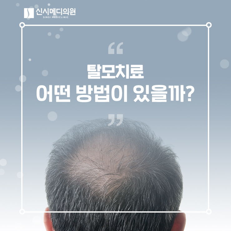  전주남성탈모 원인과 탈모약 처방으로 스트레스 해결!