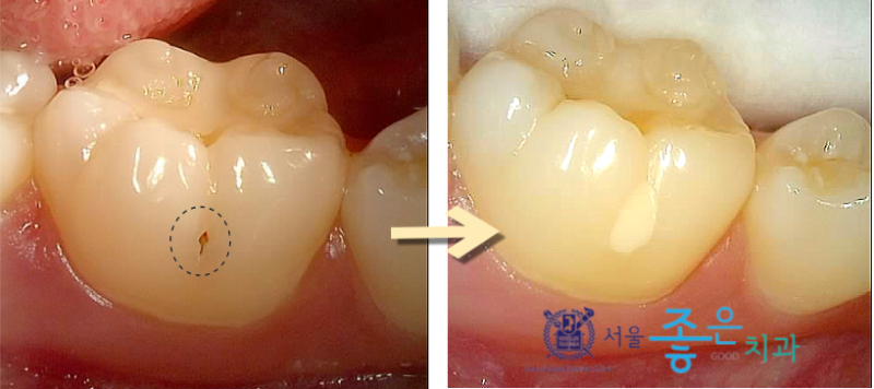 보험 충치치료 태평역치과 서울좋은치과 – 초기 충치는 모두 치료해야 할까요? 2