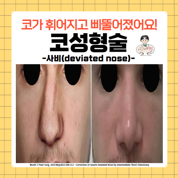  코성형술(Rhinoplasty) (10) - 사비(삐뚤어진 코, deviated nose)