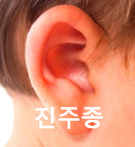  만성 중이염 진주종에 대하여 알아보자
