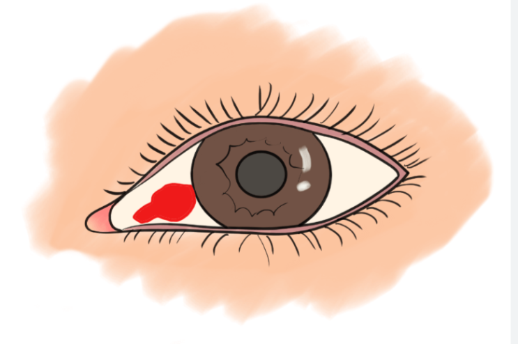 눈 실핏줄 터짐 원인 치료 눈충혈원인 안약 치료 눈 핏줄터짐