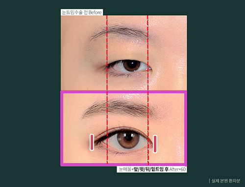  뒷밑트임한후 다시 붙을수도 있나요? <눈트임수술후기>