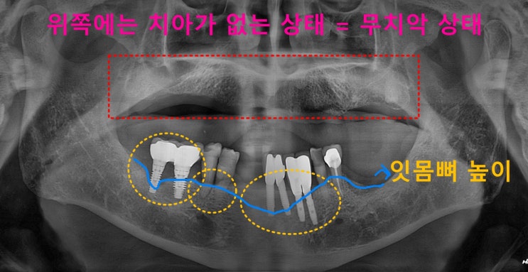  위쪽 틀니가 잘 빠져요 - 편악 틀니