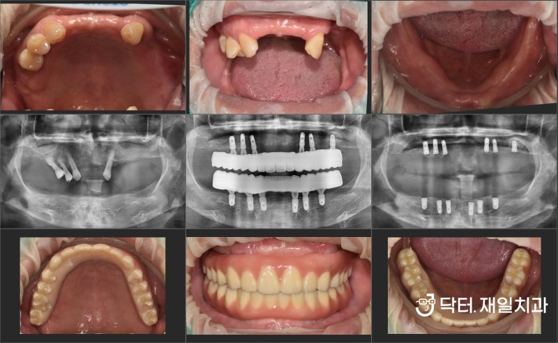 매직4 임플란트 틀니를 이용한 무치악 전악 임플란트 수술. 부비동 거상술은 수면마취 하에 편안하게 시행할 수 있습니다. Chengnei Cave, Ji Cave, Duncun Cave.