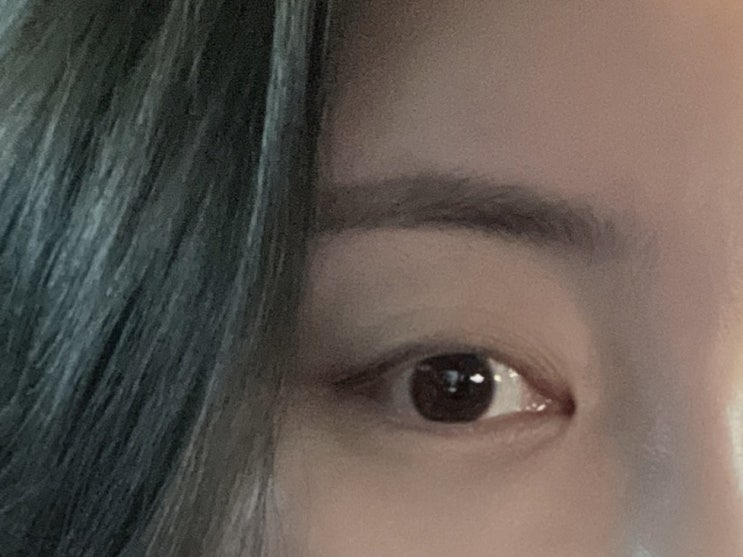  눈매교정 매몰법 상담후기