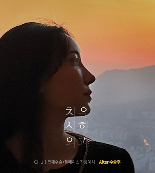  < 신사역성형외과 , 치유 > 상담,수술예약 증가로 대기시간발생