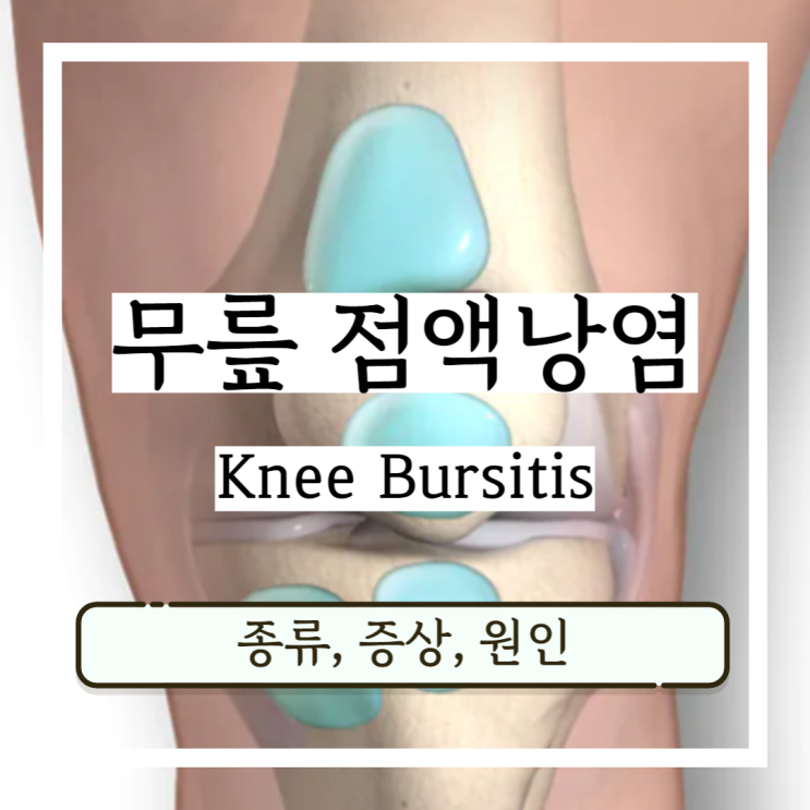 무릎 점액낭염 종류, 증상, 원인 무릎 점액낭염 종류, 증상, 원인