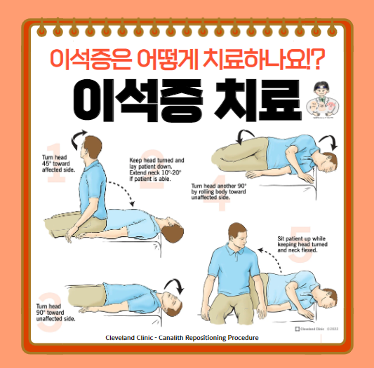  어지럼증의 가장 흔한 질환! (2) - 이석증(BPPV)의 치료