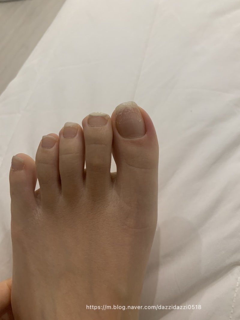 발톱 조갑주위염 치료과정(약물치료,정형외과 수술-발톱절제술) : 네이버 블로그, image size:800x1067