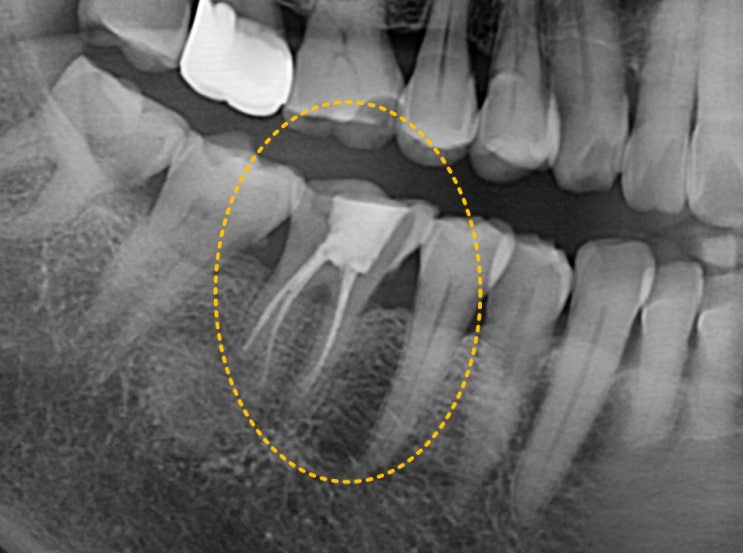 어금니 신경치료 후 치아가 깨졌어요 하남 미사치과