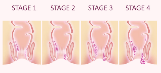 The timing of treatment for hemorrhoids in pregnant women at Ilsan Anus Surgery is important