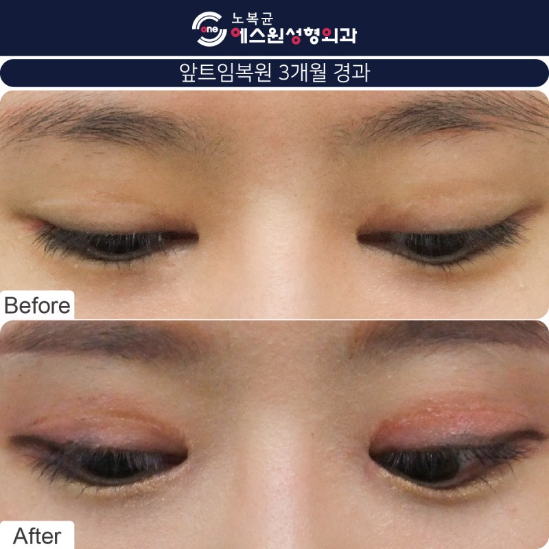 안각재건술을 고려하고 계시다면 압구정성형외과 6