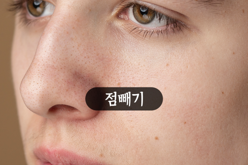 얼굴 눈 비립종 원인, 유수분밸런스 아이나코 마유크림 효능