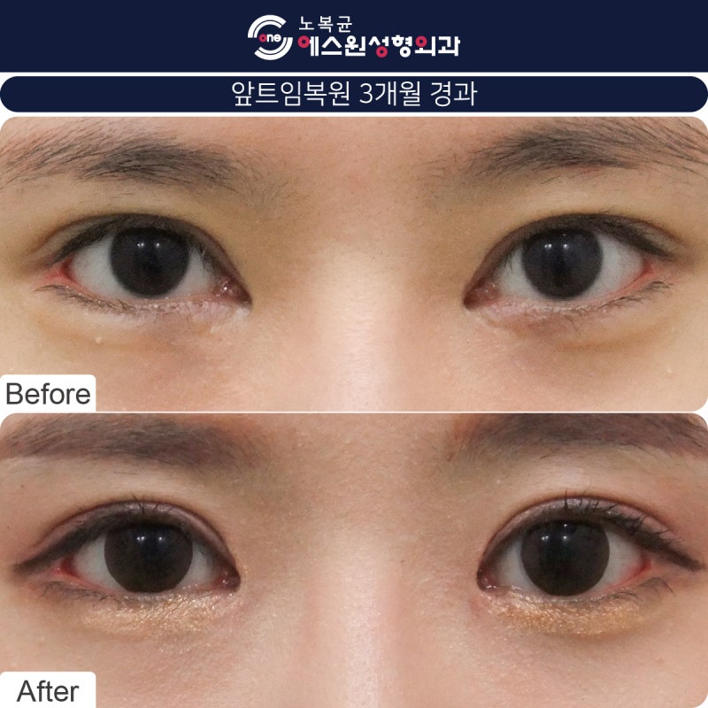 안각재건술을 고려하고 계시다면 압구정성형외과 4