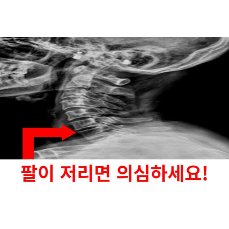  광주목디스크, 팔이 저리다면 꼭 봐야 할 글