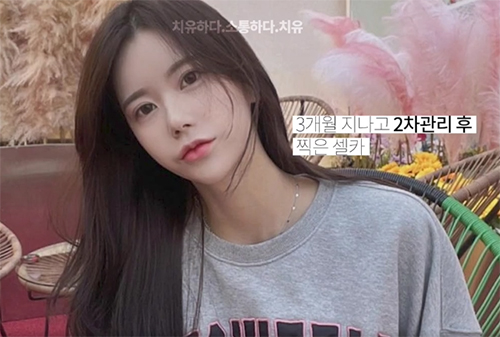  직원도 반한 슈크링리프팅 / 주름개선, 탄력증진 < 슈링크맛집후기 >