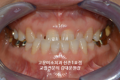  주걱턱 반대교합 3급부정교합 어금니가 결손된 40대 교정치료 신촌교정전문의 고운미소 신촌1호점 치료증례