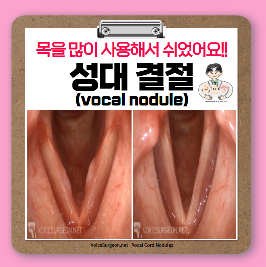  쉰 목소리 (1) - 성대결절(vocal nodule)