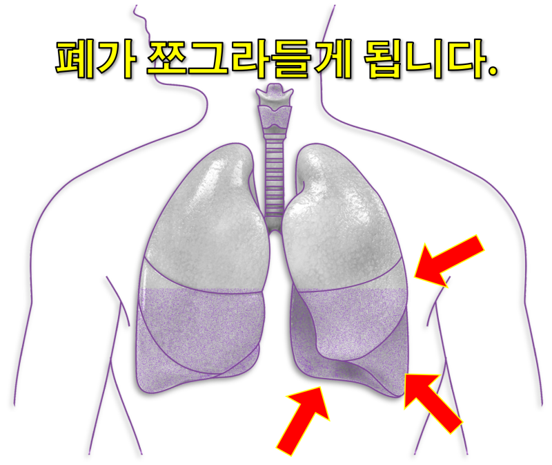 군대 시절 기흉으로 중환자실_기흉 원인과 증상, 시술 후기 : 네이버 블로그