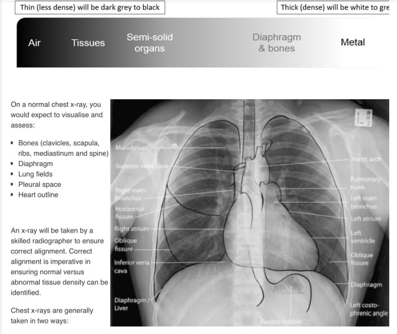 Chest PA & AP 흉부 X-ray 비용 및 판독 공부하기 : 네이버 블로그