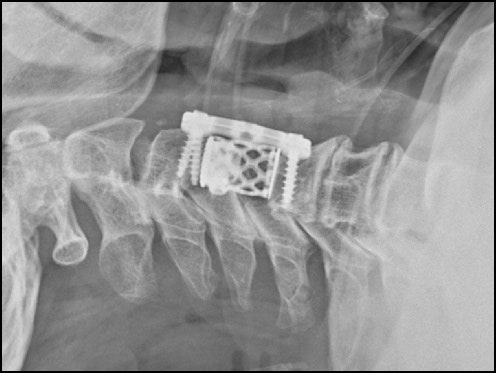 목 디스크 수술 종류 정리해 봅니다 / 추간판 탈출증 내시경 시술 / PECD(PECAN), LAMINECTOMY, ACDF ...