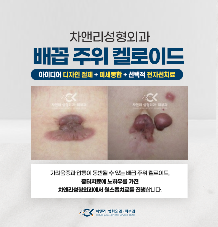  배꼽주위에 켈로이드가 생겼다!