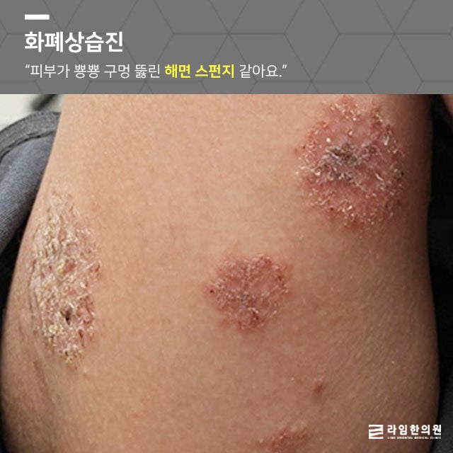 화폐상 습진 치료 분당 찾아보니