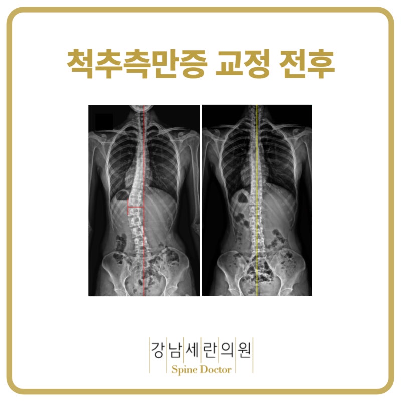 진실 (원인과 치료) 사춘기 특발성 척추측만증에 대해 몰랐습니다 2