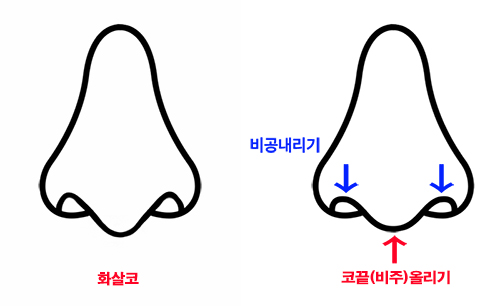  화살코수술시 비순각교정 필수? < 비중격연장술, 비주지지대 >