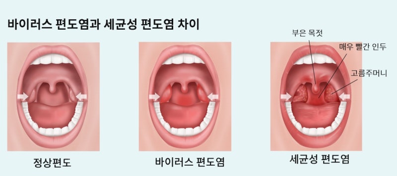편도선 부었을 때의 증상과 치료(편도염/편도염)