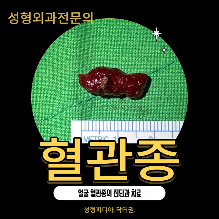 [혈관종] 얼굴 혈관종의 증상과 치료 (feat. 혈관종 제거수술)