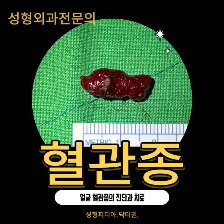  [혈관종] 얼굴 혈관종의 증상과 치료 (feat. 혈관종 제거수술)