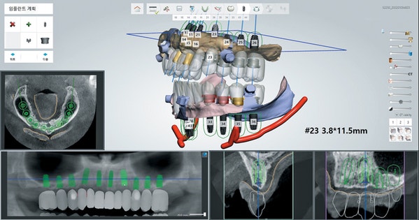 안산 전체 임플란트