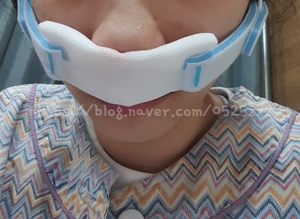 [비염 축농증 수술 후기2]비염 수술 축농증 편위된 비중격 수술 알레르기비염 입원기간 거즈 코소독 코청소 수술비 병원비 실비 보험청구 회복기간 부작용 후유증 비염재발 코성형