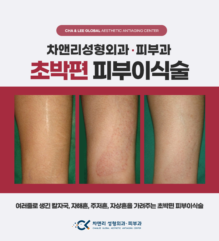  칼에 베인 상처 자상흉터