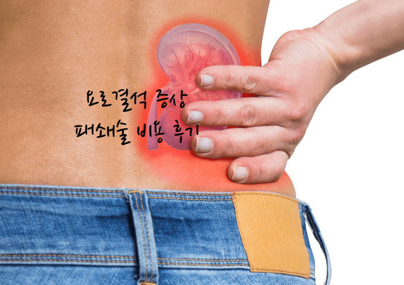 요로결석 증상 파쇄술 비용 후기